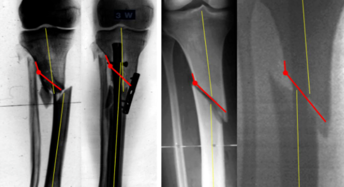 【手术技术】如何避免胫骨近端骨折髓内钉对位不良