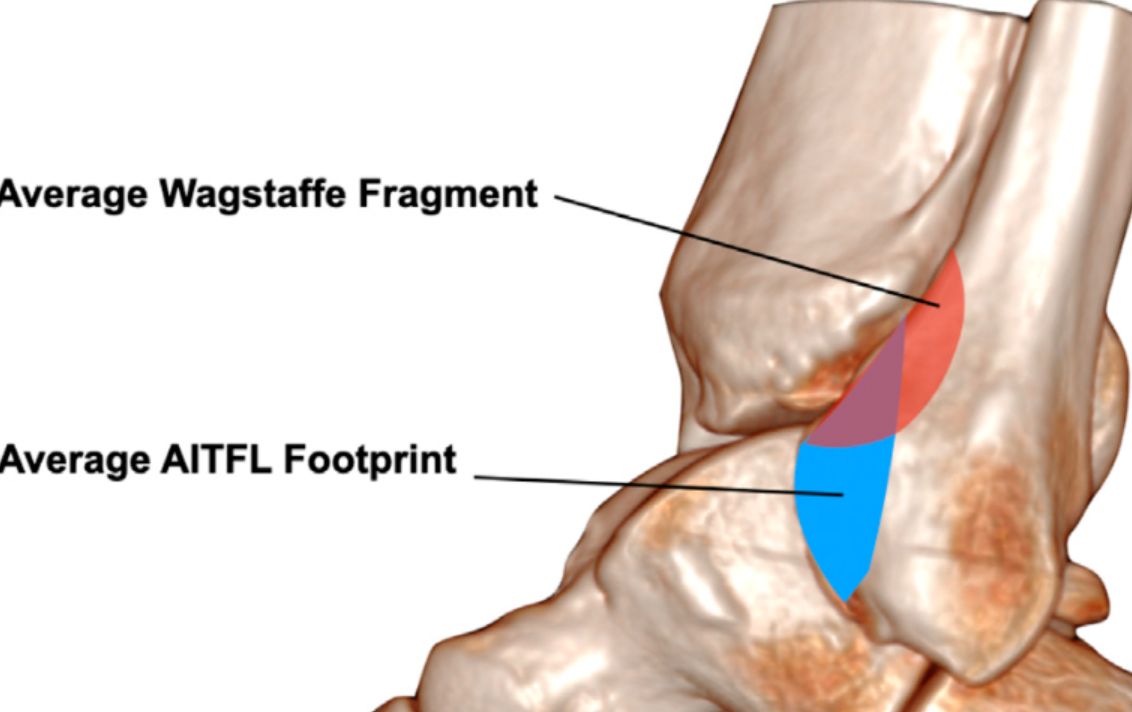【踝关节骨折】Wagstaffe-Le Fort骨折最新分型