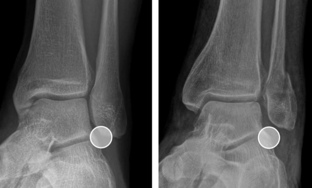如何评估外踝复位不良或畸形愈合？