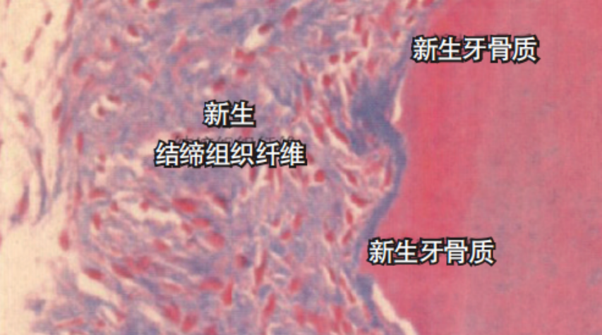 牙周再生治疗技术的临床效果