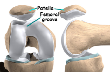 髌骨软化，到底哪里软了？