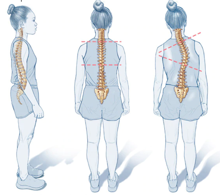 一文了解结构性脊柱侧凸（Structural Scoliosis）