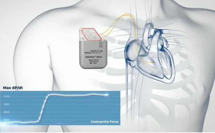 心血管病的最后战场，心衰器械治疗新进展