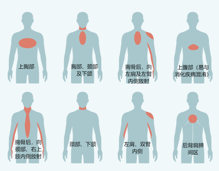 不止胸骨后！典型心绞痛位置，这9个字概括全了