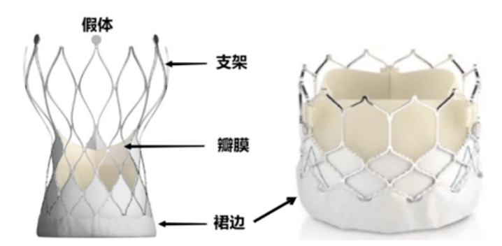 防止主动脉瓣植入发生瓣周漏，得注意这5条……