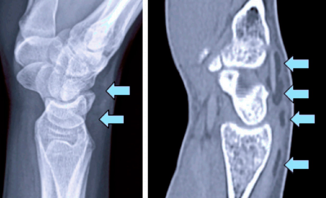 腕伸肌腱“浮脂”征象:桡骨远端隐匿性骨折