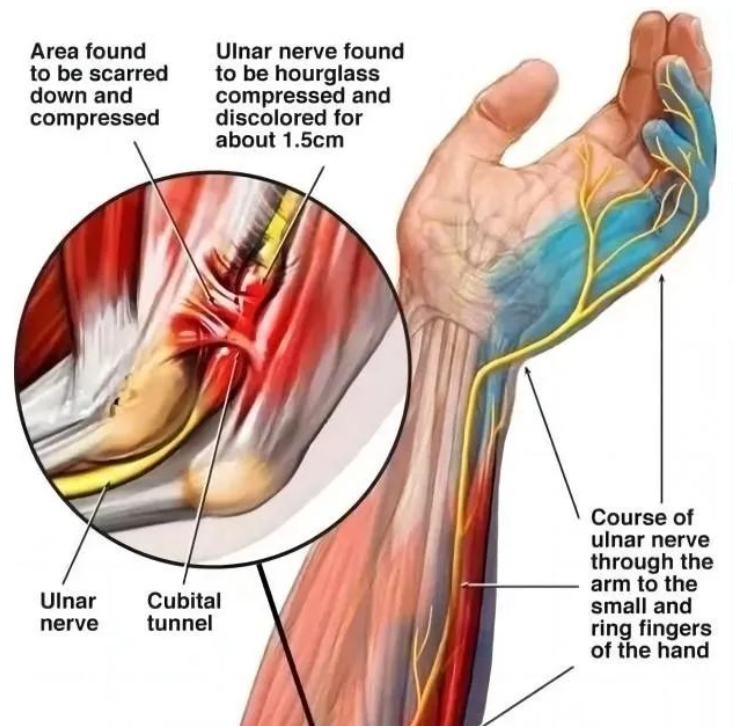 【手术技术】肘关节镜技术系列——尺神经处理