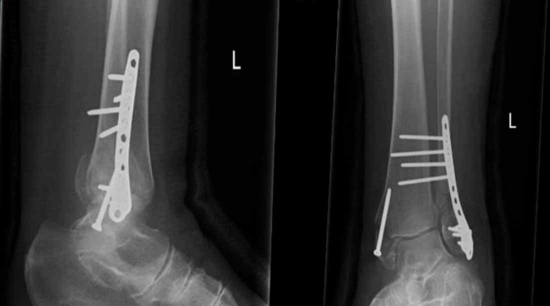 【手术技巧】胫骨加强螺钉技术（Pro-Tibial Screws）治疗骨质疏松性踝关节骨折