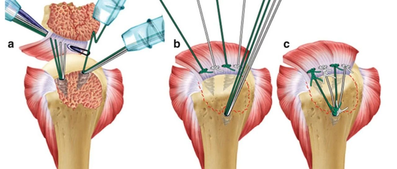 早读【手术技巧】肱骨大小结节骨折铆钉复位内固定技巧