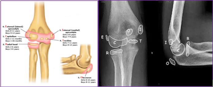 早读 | 图文并茂：快速掌握儿童肘部损伤的影像学评估