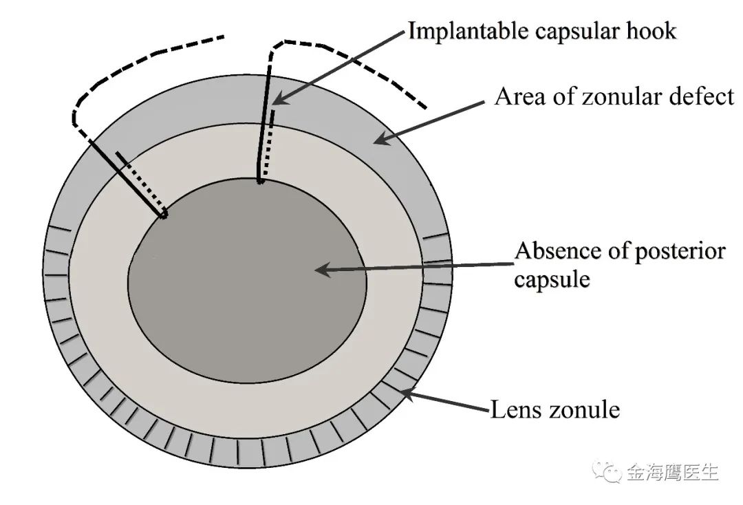金海鹰医生：植入性囊袋拉钩的另一用途——重建囊膜支撑、植入睫状沟