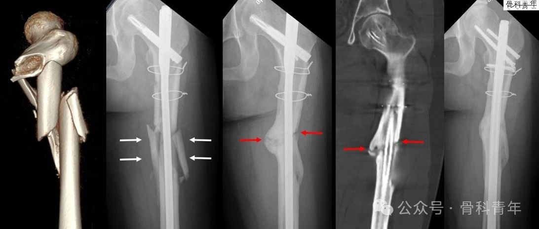 早读 | 粗隆下骨折行髓内钉内固定，什么最关键？