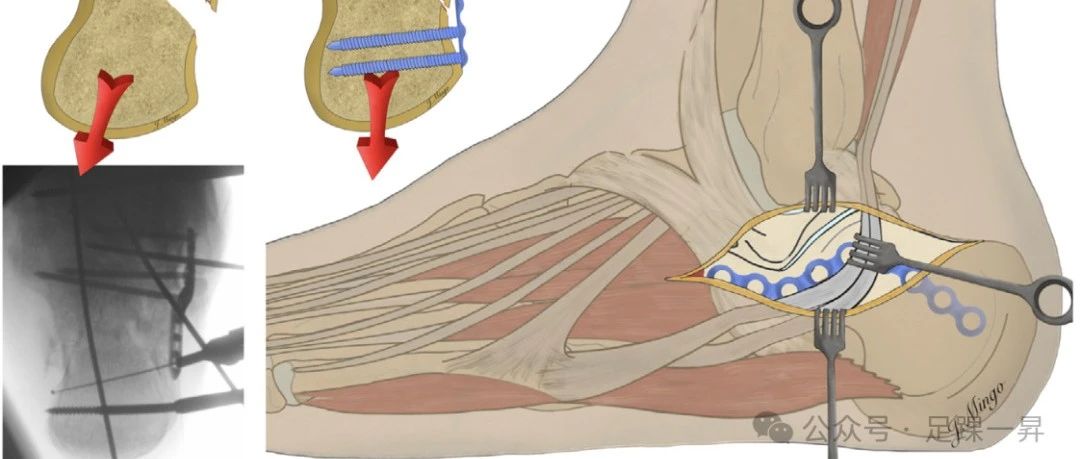 手术技巧｜经跗骨窦入路治疗跟骨骨折的西班牙经验
