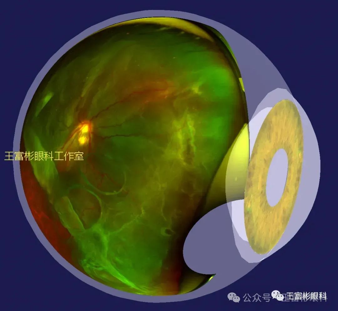 后天性视网膜劈裂症：临床层面的甄别