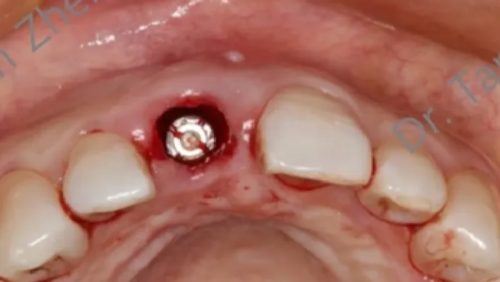 不可忽视的角色——即刻种植中软组织移植的应用①