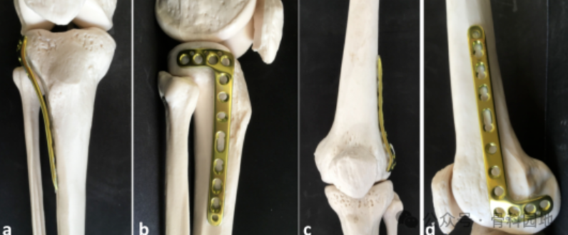 手术技巧｜巧用胫骨近端外侧板加空心螺钉治疗Hoffa骨折