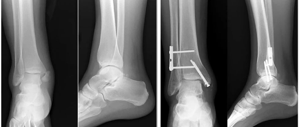 单枚螺钉与两枚螺钉固定不稳定踝关节的内踝骨折