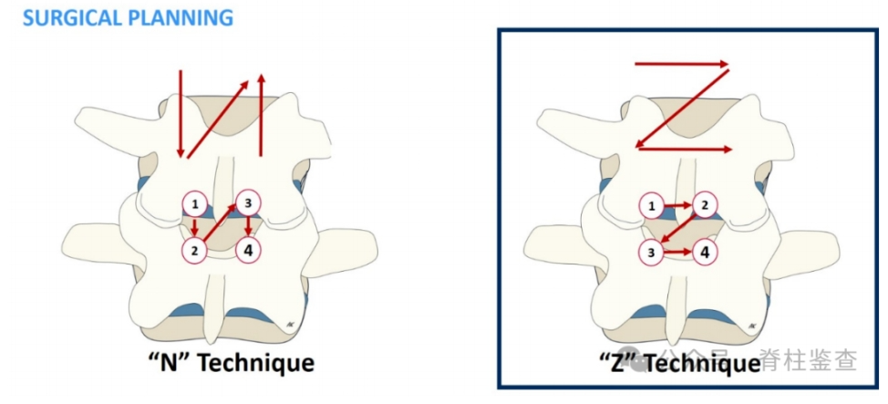 UBE手术治疗中央型腰椎管狭窄“Z”技术细节