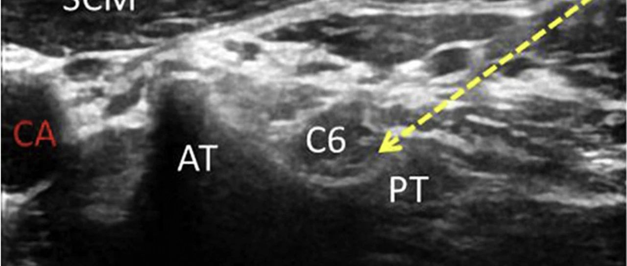 超声引导下颈椎介入技术图谱（一）：C5-7颈神经根
