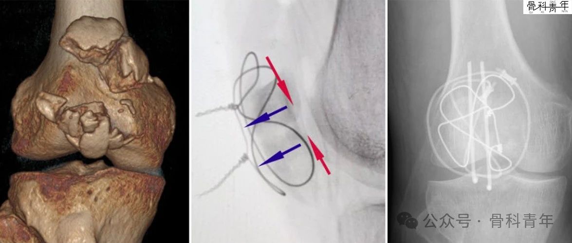 “张力带优先”法内固定治疗髌骨粉碎性骨折（C3型）