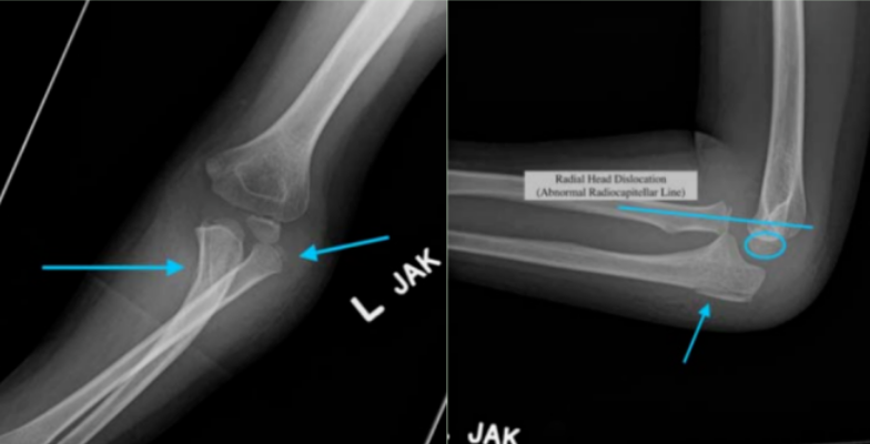 早读 | 警惕！儿童肘部骨折五大 “隐匿杀手”，务必及时识别