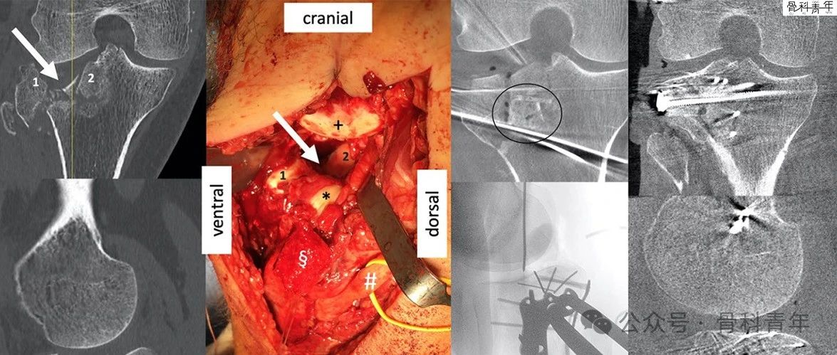 手术技巧｜外侧扩大入路联合股骨髁截骨治疗胫骨平台骨折