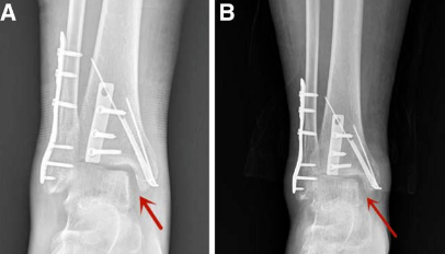 内踝骨折合并三角韧带损伤? 你可能忽略的一点！
