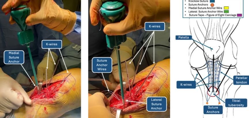 手术技术 | 减张缝线锚钉治疗胫骨结节撕脱骨折