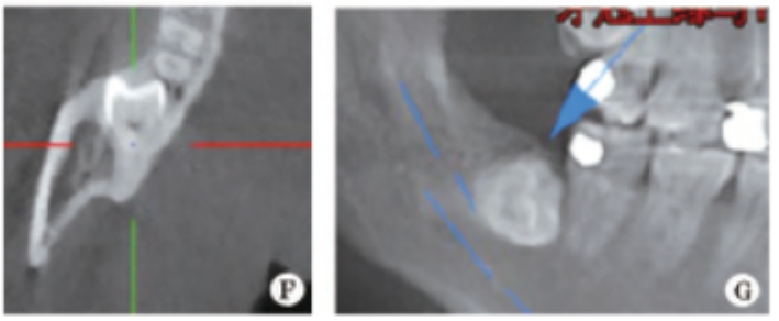 下颌阻生第三磨牙拔除后下牙槽神经永久损伤2例影像特点