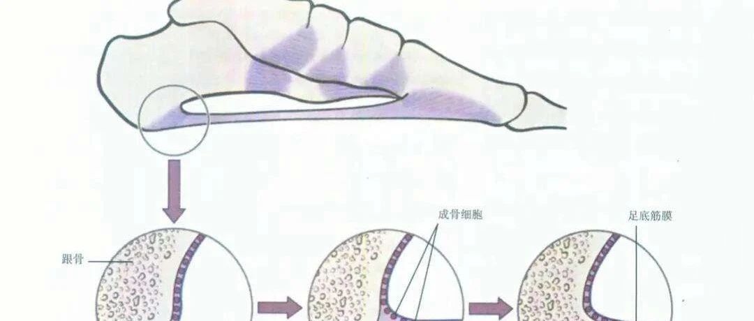 实用手术技术 | 微创治疗顽固性足底跖筋膜炎（跟骨刺、跟骨痛）