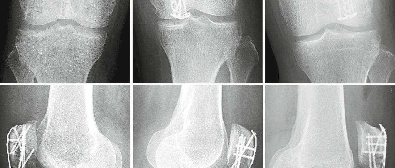 手部钢板治疗髌骨下极骨折
