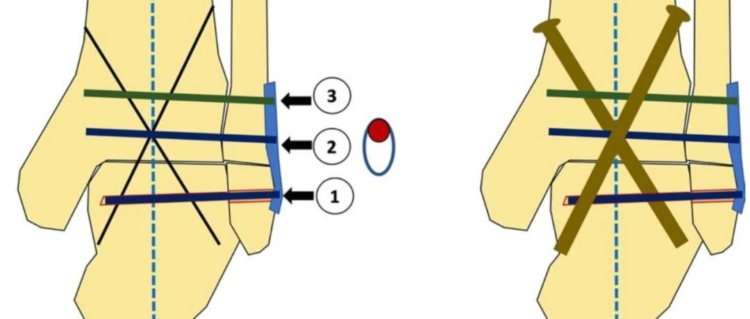 手术技巧｜微创经腓骨入路踝关节融合术