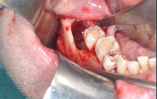 早读 | 少见!下牙槽神经显露如此明显!