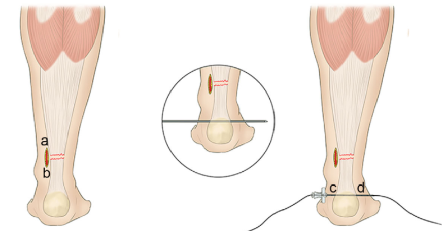 手术技巧｜介绍3种急性跟腱断裂的微创缝合方法