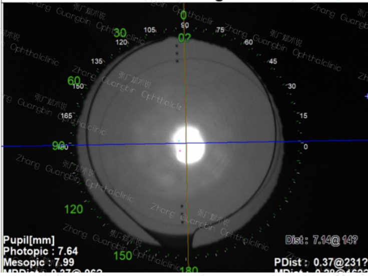 病历分享｜屈光白内障手术-低度近视患者——PanOptix Toric IOL