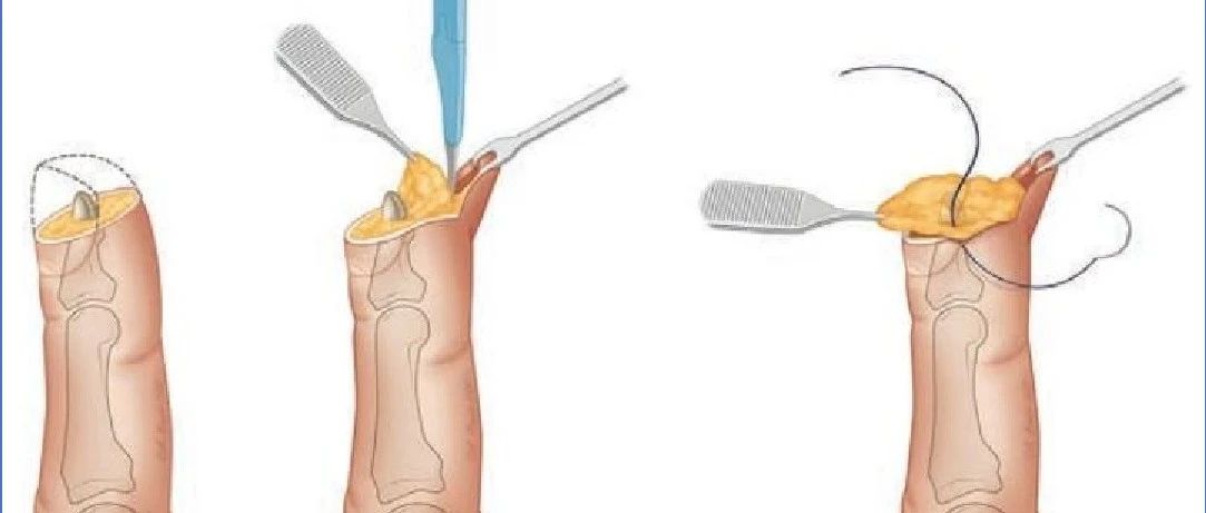 手术技术 | P3 皮瓣（纤维-脂肪皮瓣）修复指尖缺损