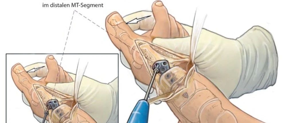手术技术 | 拇外翻之髓内板技术