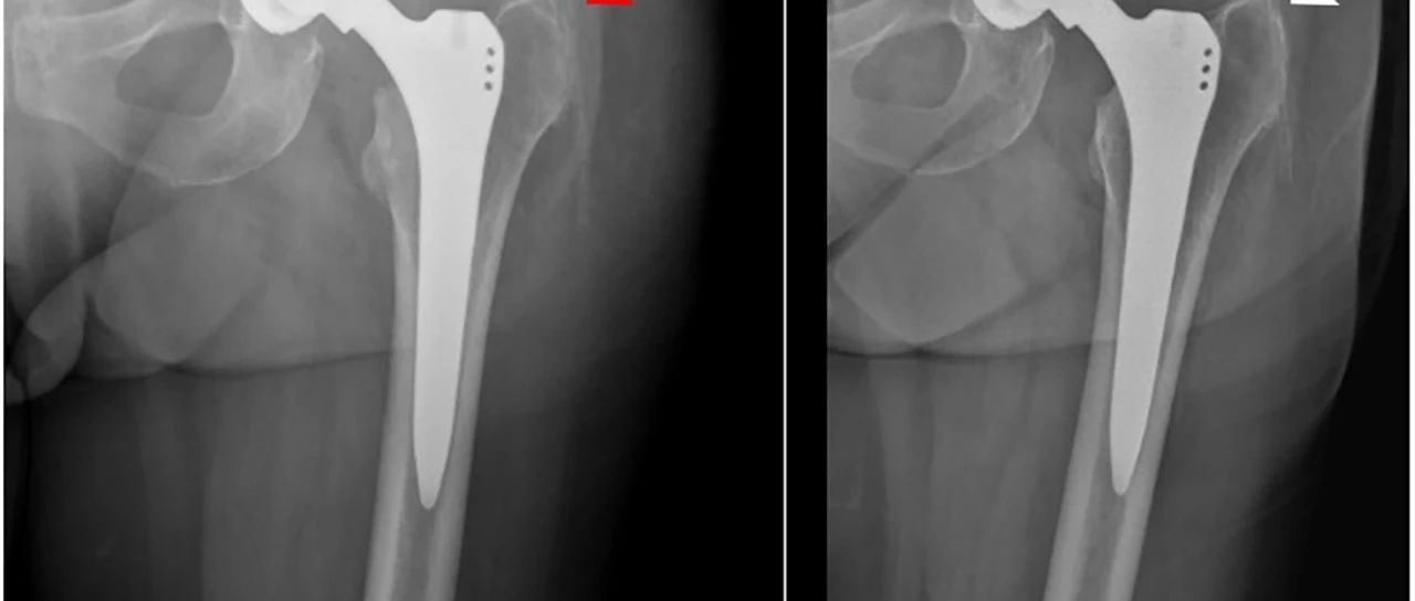 因残留引流管导致的Trendelenburg步态：全髋关节置换术