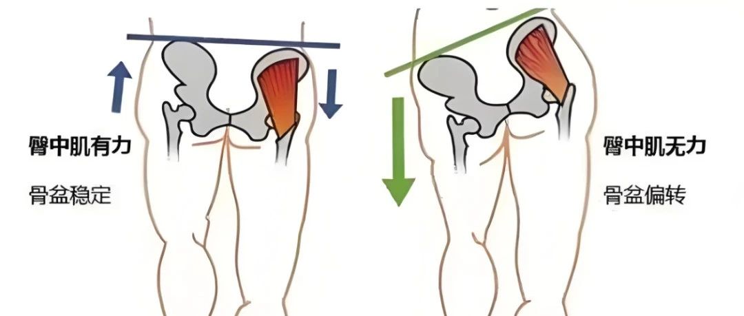 臀中肌：腰-腿-膝联动疼痛的关键治疗点
