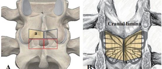 早读 | UBE黄韧带整体切除治疗椎管狭窄：“蝴蝶”技术
