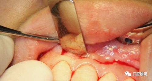 前牙根尖囊肿根尖切除手术