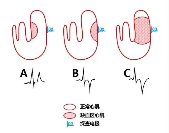 急性心梗心电图各阶段特点
