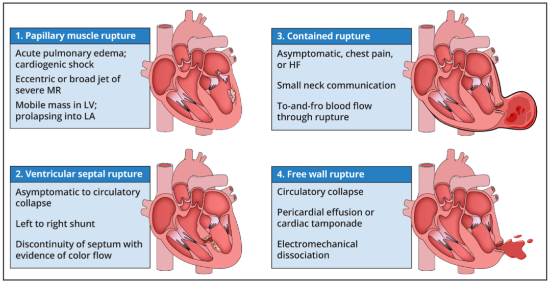 急性心梗诊疗：2025 最新指南推荐