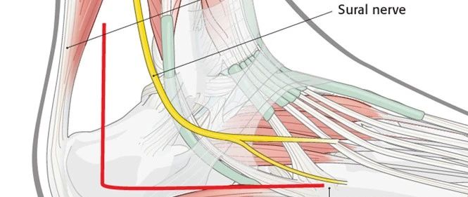 跟骨的外侧扩大入路——大L形切口