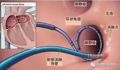 房性心动过速的心电图诊断与鉴别