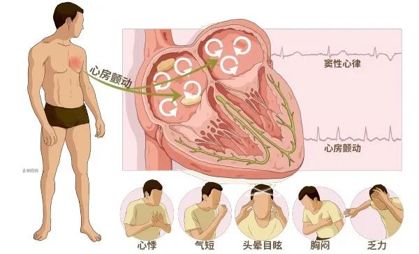 临床必备：常见心律失常之房颤的急诊处理