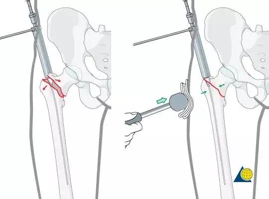 股骨粗隆间骨折PFNA内固定的4大关键总结，实用！