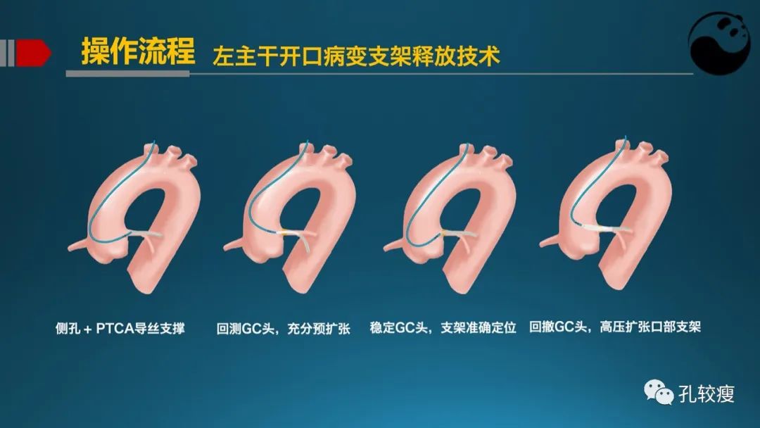 左主干指引导管的选择
