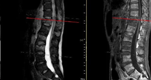 OVCF 诊断的 “影像三剑客”：如何用 X 线、CT、MRI 精准锁定骨折？
