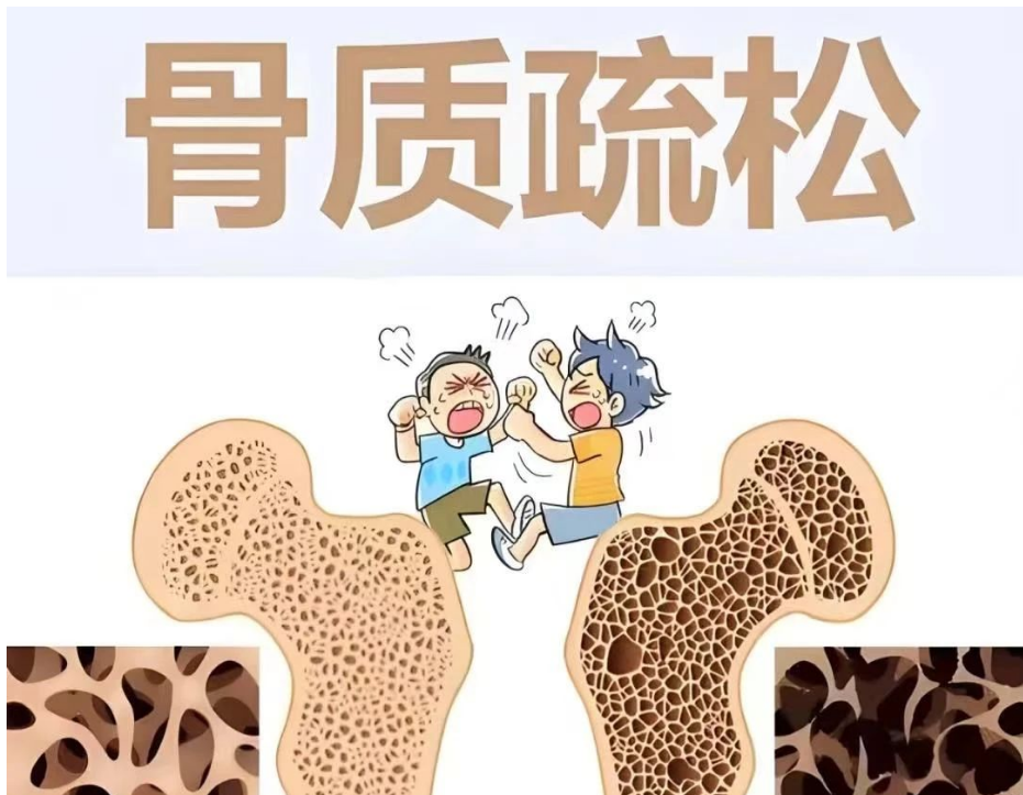 【门诊故事】没有摔跤也会骨折？揭开 “沉默的杀手”—— 骨质疏松性椎体压缩骨折的真相